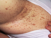 Recklinghausen's disease