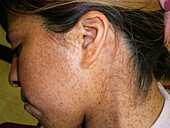 Recklinghausen's disease