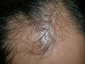 Female pattern hair loss