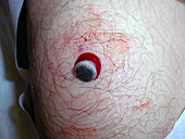 Taking biopsy of a blue naevus