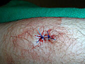 Sutures after punch biopsy