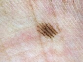 Parallel furrow pattern in mole, dermoscopy