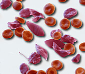 Sickle cell anaemia, SEM