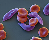 Sickle cell anaemia, SEM