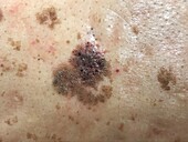 Seborrheic keratosis, dermoscopy