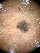 Seborrheic keratosis, dermoscopy