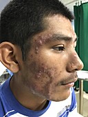 Nodulocystic acne