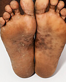 Secondary syphilis lesions on a man's feet