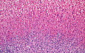 Organising blood clot, light micrograph