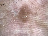 Parallel furrow pattern in mole, dermoscopy