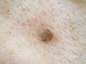 Seborrheic keratosis, dermoscopy