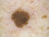 Seborrheic keratosis, dermoscopy