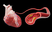 Coronary artery disease, illustration