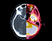 Normal brain, CT and CT-PET scan