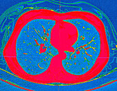 Healthy lungs, CT scan