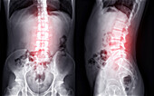 Lumbar spine, X-ray