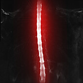 Healthy thoracic spine, myelogram