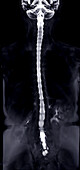 Healthy spinal column, myelogram