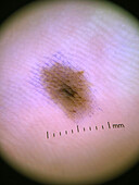 Mole on the sole of the foot, dermoscopy