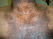Darier's disease