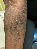 Prurigo nodularis in mixed connective tissue disease
