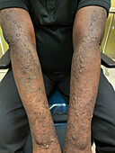 Prurigo nodularis in mixed connective tissue disease