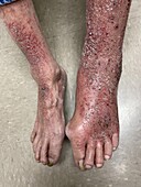 Delusional infestation and contact dermatitis