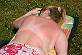 Young woman with sunburnt back