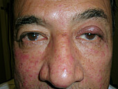 Ocular rosacea and stye