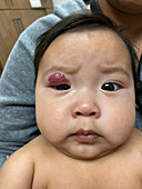 Infantile haemangioma