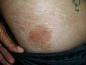 Improving mycosis fungoides