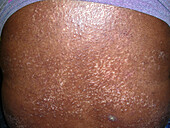 Salt and pepper pigmentation in scleroderma