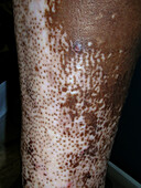Salt and pepper pigmentation in scleroderma