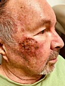 Reaction to lentigo maligna melanoma treatment