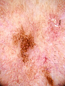 Lentigo maligna melanoma, dermoscopy