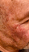 Lentigo maligna melanoma during treatment
