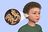 Otitis media in a child, illustration