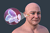 Otitis media in a man, illustration