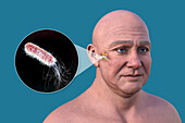 Otitis media in a man, illustration