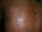 Recklinghausen's disease