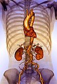 Torso blood vessels, 3D CT scan