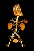 Torso blood vessels, 3D CT scan