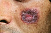 Lupus erythematosus on the face