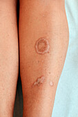 Diabetic skin lesions
