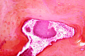 Actinomycosis bone infection, micrograph