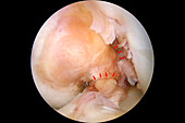 Ruptured knee ligament, endoscopy