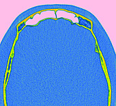 Normal frontal sinus, CT scan