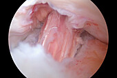 Repaired ruptured knee ligament