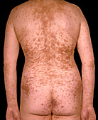 Pemphigus foliaceus lesions