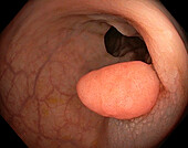 Colon polyp, endoscope view